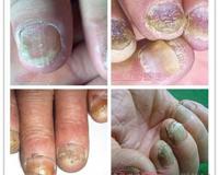 灰指甲初期症状图片及表现