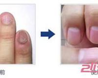 灰指甲的不同症状图片及愈后对比图