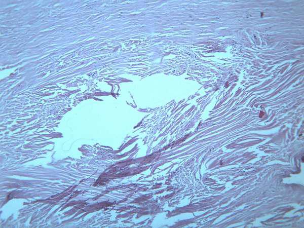 纤维瘤 显微图片