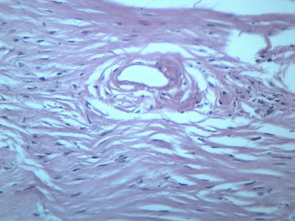 纤维瘤 显微图片